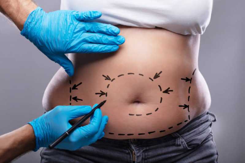 Abdominoplastia Circunferencial Marcar Itatiaia - Abdominoplastia com Lipo