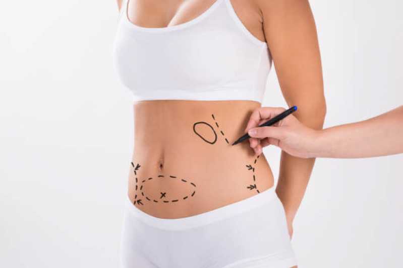 Abdominoplastia em âncora Marcar Araruama - Mini-abdominoplastia