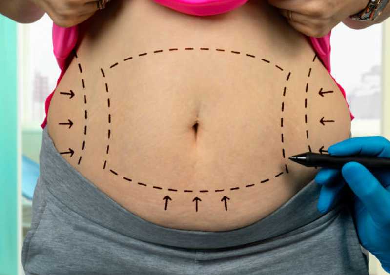 Abdominoplastia para Mulher Catete - Mini-abdominoplastia