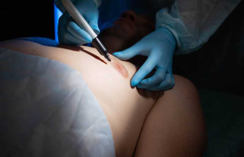 Cirurgia de Ginecomastia Bilateral Masculina Marcar Porto Real - Cirurgia de Ginecomastia Masculina