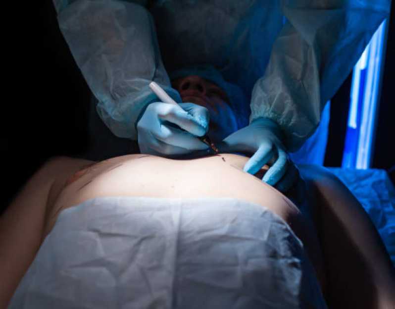 Cirurgia de Ginecomastia Homem Gamboa - Cirurgia de Ginecoplastia