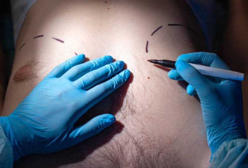 Cirurgia de Ginecomastia Neonatal Marcar Petrópolis - Cirurgia de Ginecomastia Bilateral