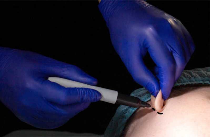 Cirurgia de Lobuloplastia Marcar São Conrado - Cirurgia para Correção de Orelha de Abano
