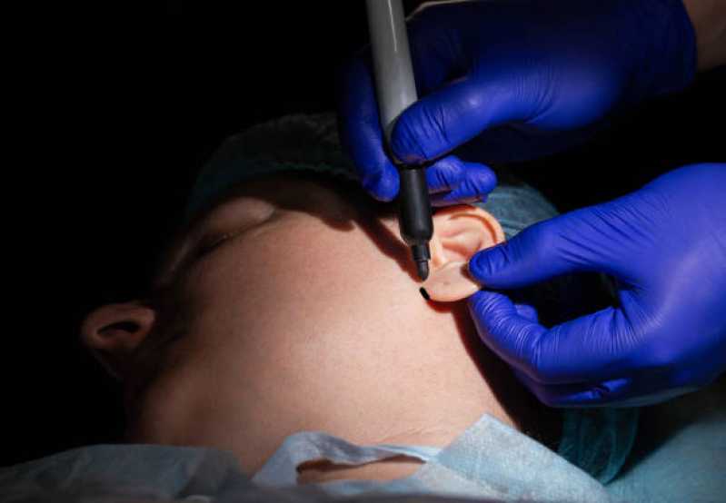 Cirurgia de Lobuloplastia Porto Real - Cirurgia para Orelha Rasgada