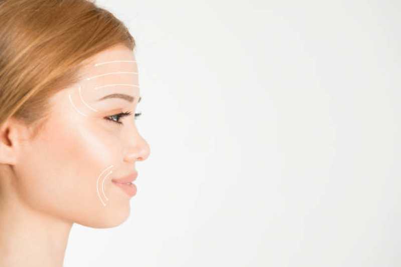 Cirurgia de Mini Lifting Facial Agendar Cidade Nova - Cirurgia de Lifting de Coxa