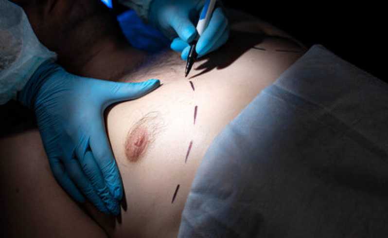 Mamoplastia Bilateral Clínica Raposa - Mamoplastia Homem