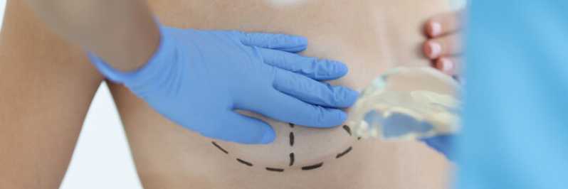 Mamoplastia com Enxerto de Gordura Itaperuna - Mamoplastia com Prótese
