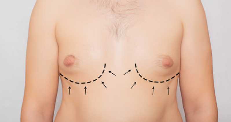 Mamoplastia Homem Centro - Mamoplastia com Gordura