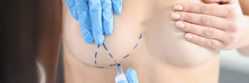Mamoplastia Periareolar Clínica Rio das Ostras - Mamoplastia com Prótese