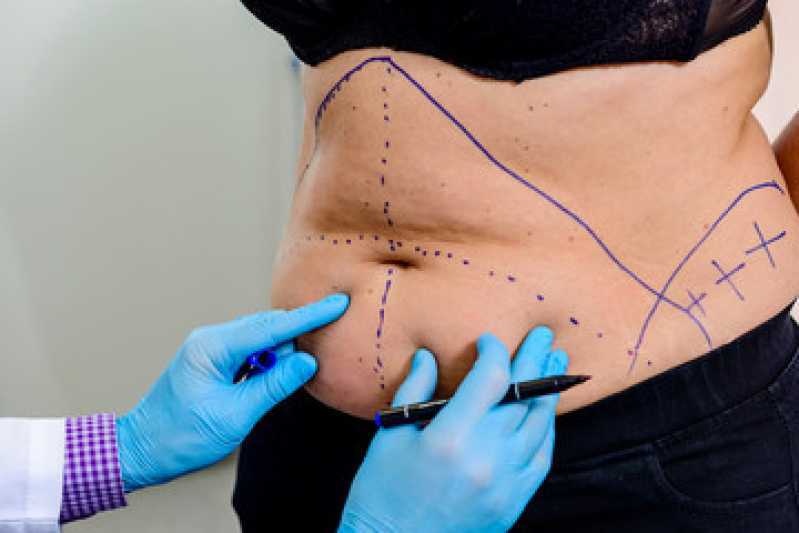 Mini-abdominoplastia Marcar Mesquita - Cirurgia de Abdominoplastia