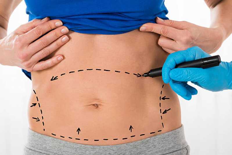 Onde Faz Abdominoplastia para Mulher Vidigal - Cirurgia de Abdominoplastia
