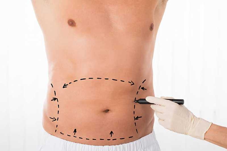 Onde Faz Cirugia Abdominoplastia Catete - Abdominoplastia Circunferencial
