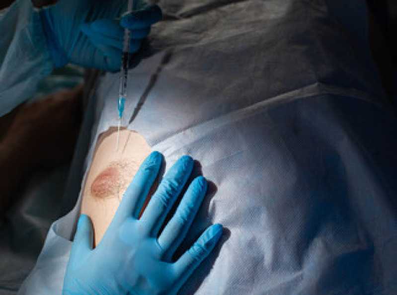 Onde Faz Mamoplastia Bilateral Caju - Mamoplastia Homem