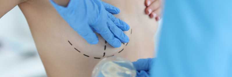 Onde Faz Mamoplastia com Enxerto de Gordura Santo Cristo - Mamoplastia Periareolar