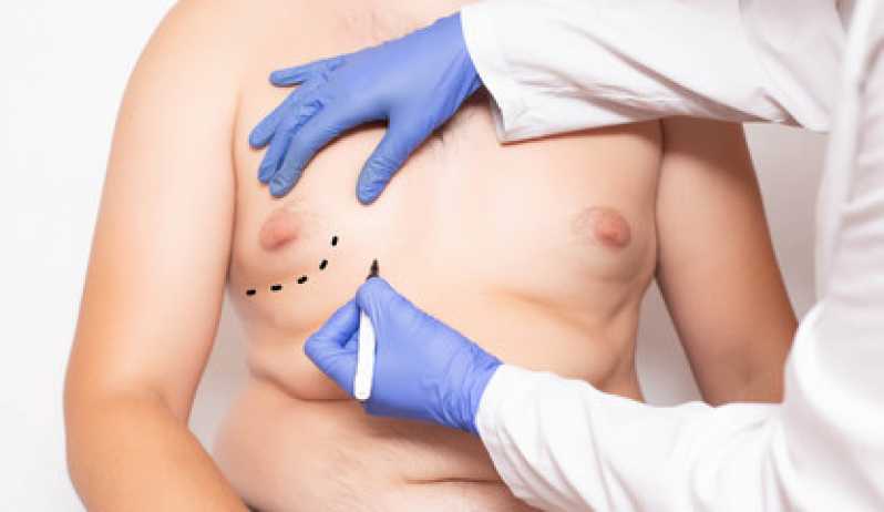 Onde Faz Mamoplastia Homem São João da Barra - Mamoplastia com Gordura