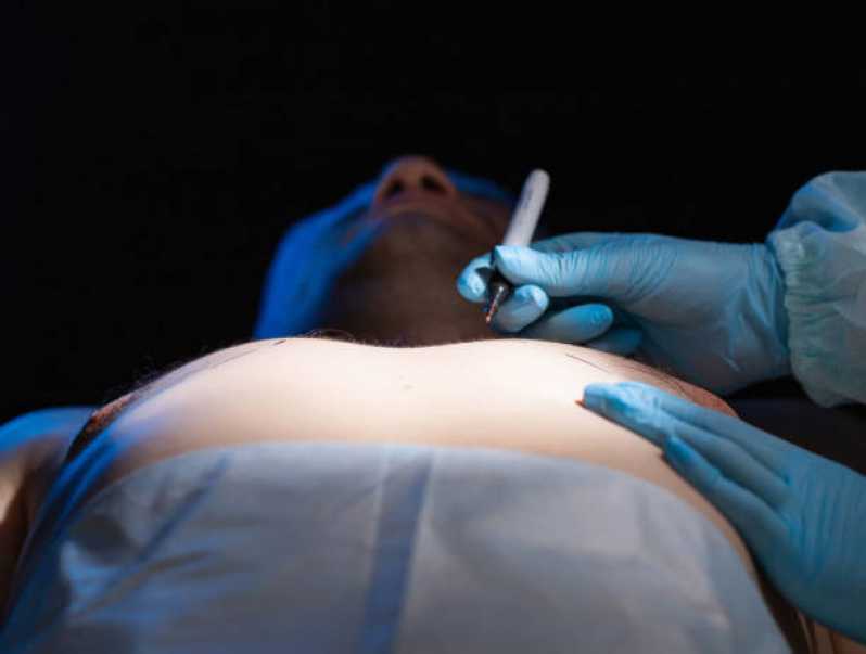 Onde Fazer Cirurgia de Ginecomastia para Homens Copacabana - Cirurgia de Ginecoplastia