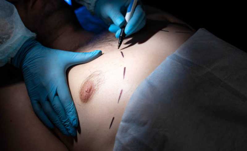 Onde Fazer Cirurgia de Ginecoplastia Catumbi - Cirurgia de Ginecomastia Masculina