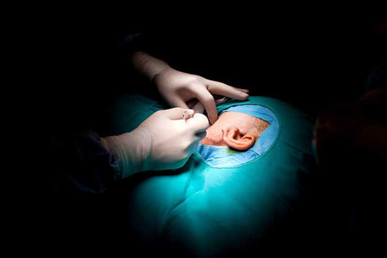 Onde Fazer Cirurgia de Lobuloplastia Maricá - Cirurgia de Redução de Orelha