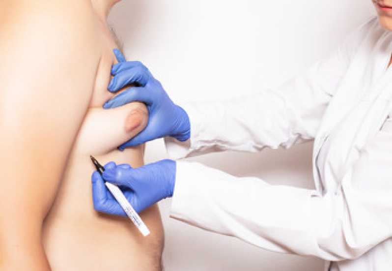 Onde Fazer Mamoplastia Bilateral Angra dos Reis - Mamoplastia Masculina