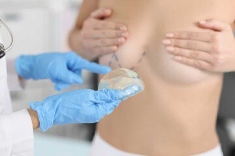 Onde Fazer Mamoplastia Cirurgia Armação dos Búzios - Mamoplastia Híbrida