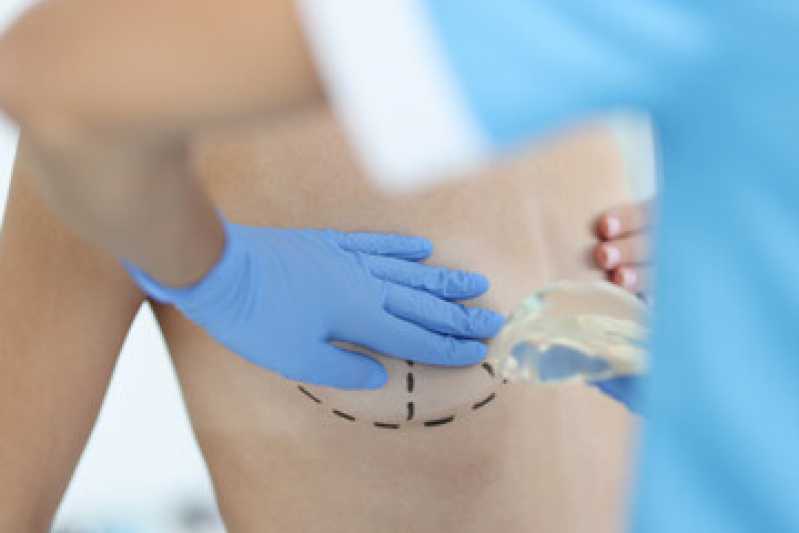 Onde Fazer Mamoplastia Masculina Magé - Mamoplastia com Gordura