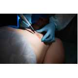 cirurgia de ginecomastia bilateral masculina marcar Lagoa