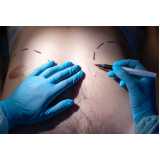 Cirurgia de Ginecomastia Neonatal