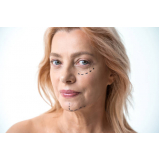 cirurgia dermatológica do rosto marcar Itaperuna