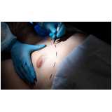 mamoplastia bilateral clínica Nova Friburgo