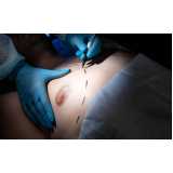 onde fazer cirurgia de ginecoplastia Glória
