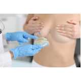 onde fazer mamoplastia cirurgia Campos dos Goytacazes