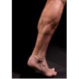 prótese de silicone nas pernas Raposa