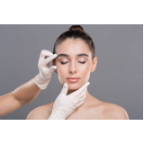 tratamento de lifting facial com fios de pdo Seropédica