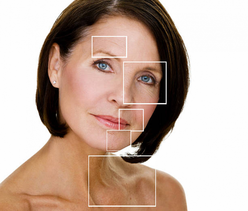 Tratamento de Mini Lifting Facial Vidigal - Mini Lifting Facial